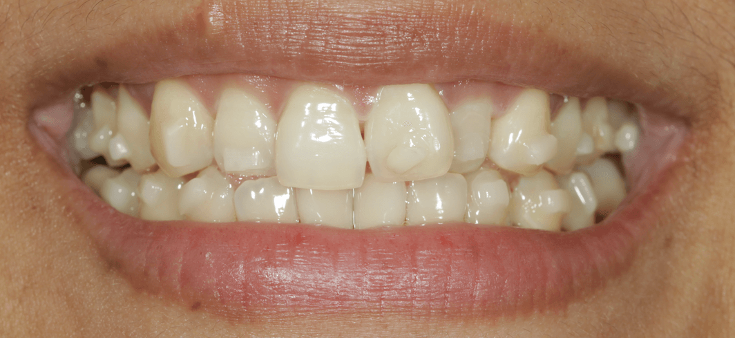 Trays off. White square attachments on the front teeth.