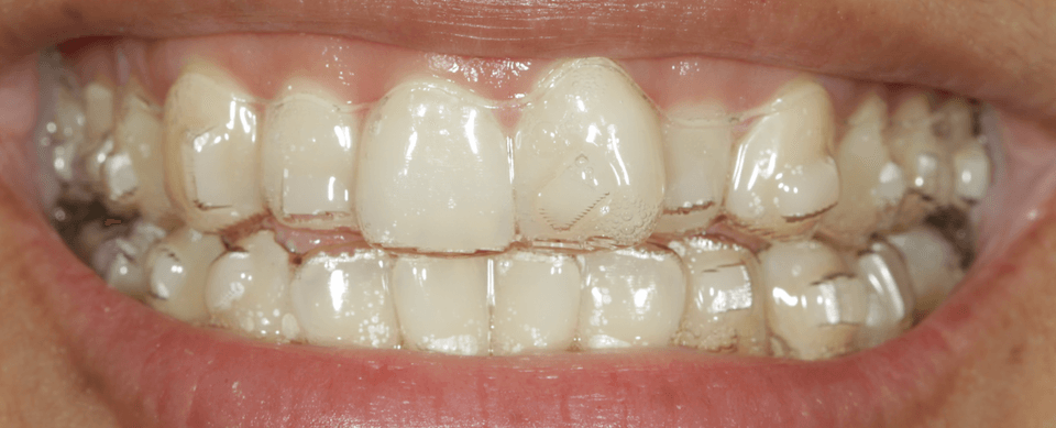 Clear aligner trays on, with white square attachments on the front teeth.