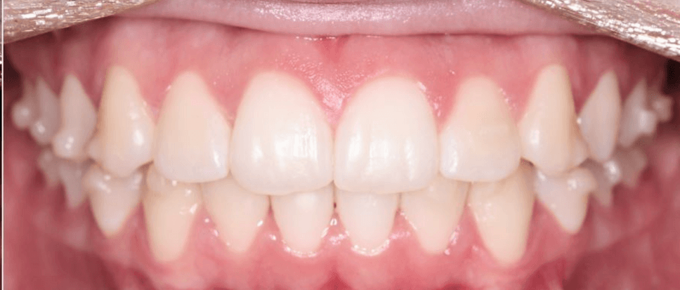 Trays off. No attachments on the visible surfaces of the front teeth.