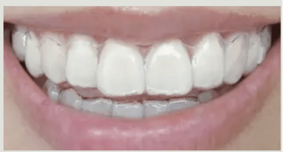 Clear aligner trays on. No attachments on the visible surfaces of the front teeth.